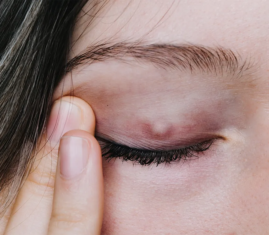chalazion on the upper eyelid