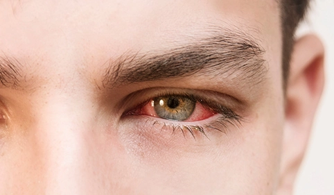 young man with conjunctivitis