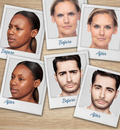 botox dysport before and afters