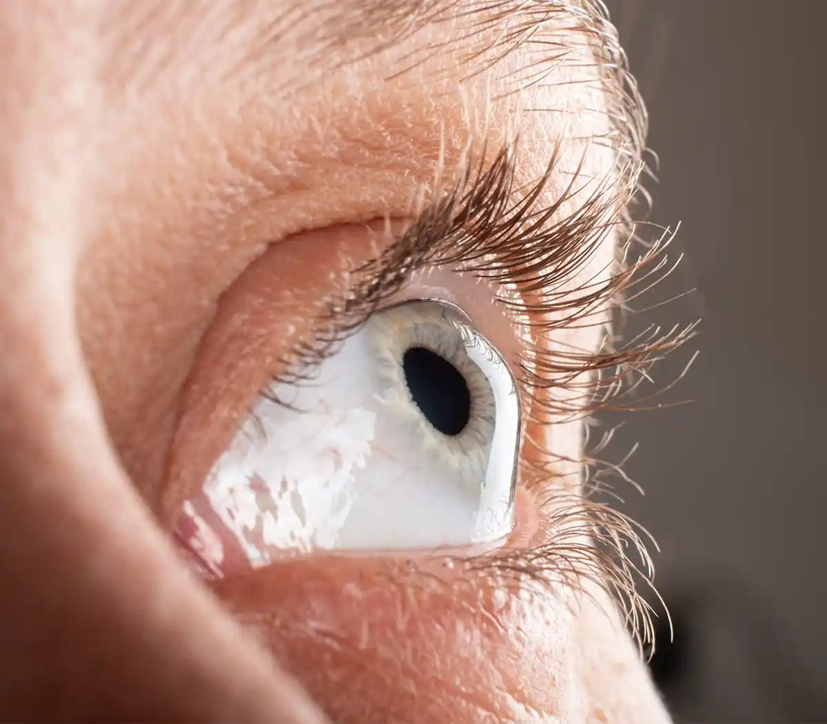 eye with keratoconus