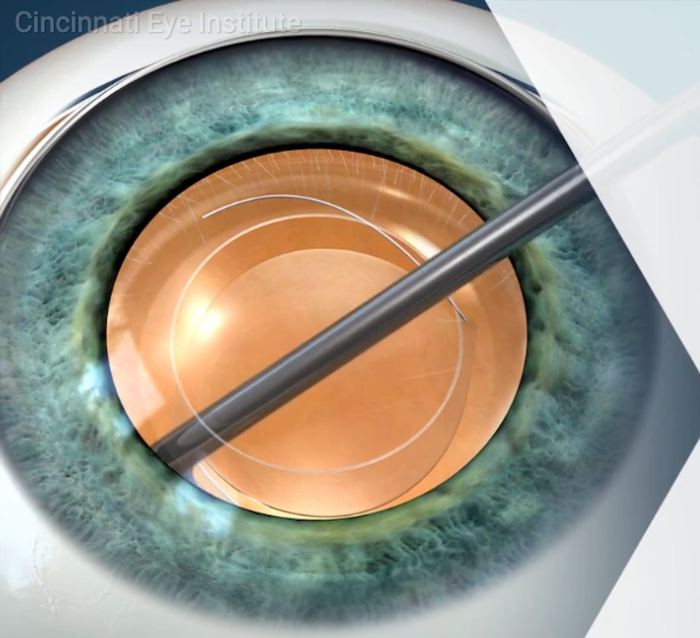 cataracts video preview