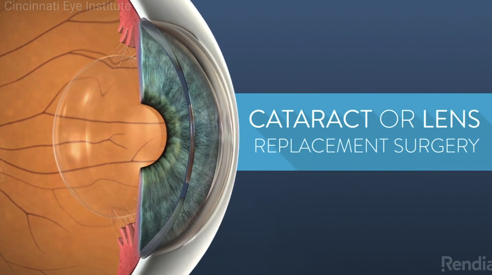 cataract replacement video preview