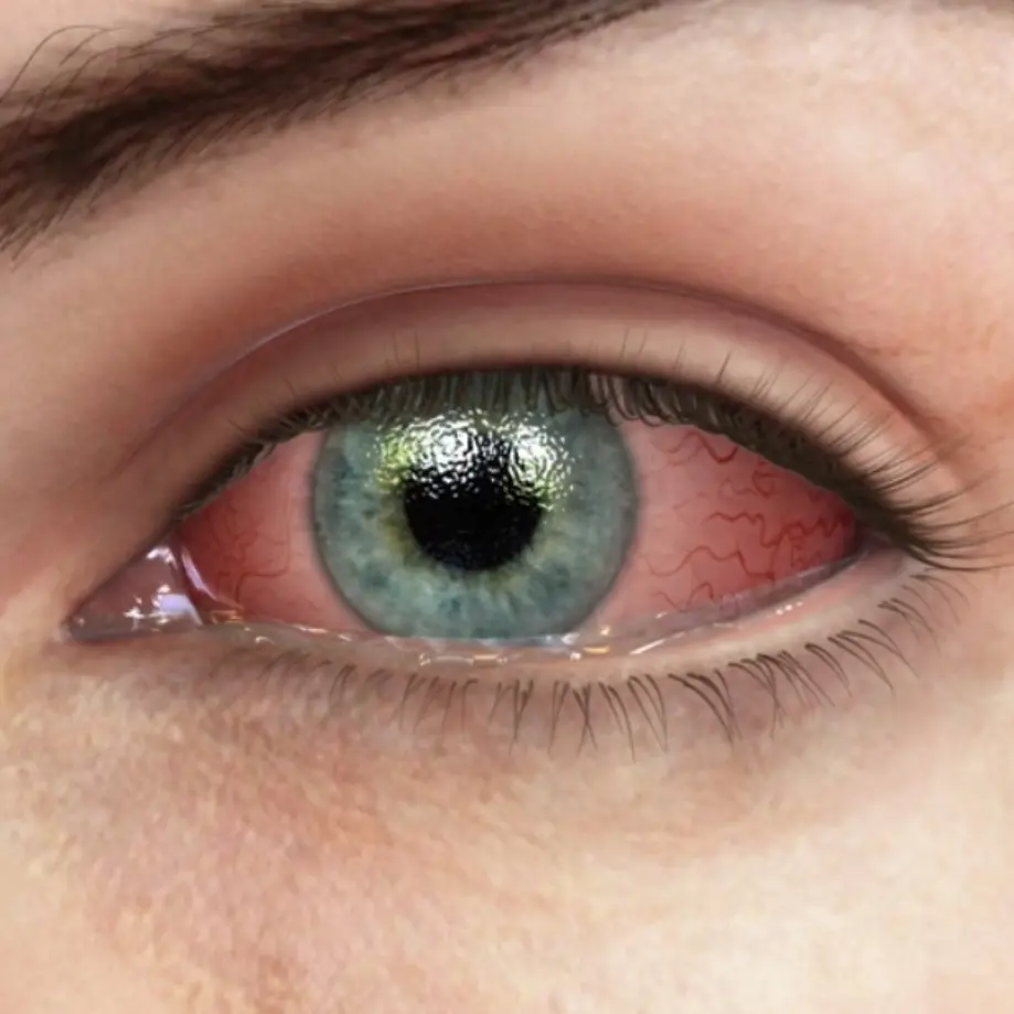 Eye infection preview