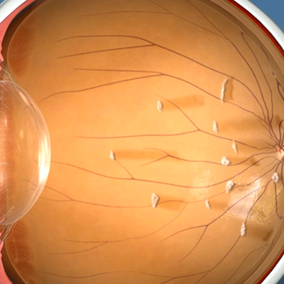 flashes floaters preview