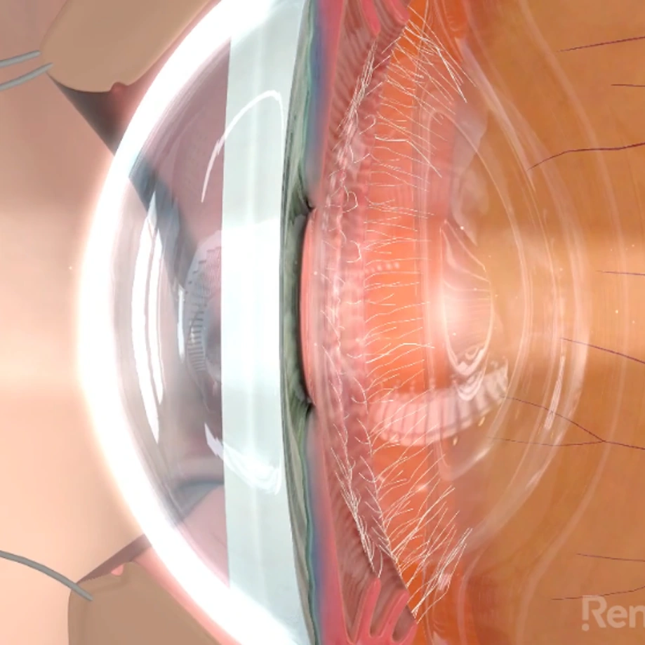 lasik video preview
