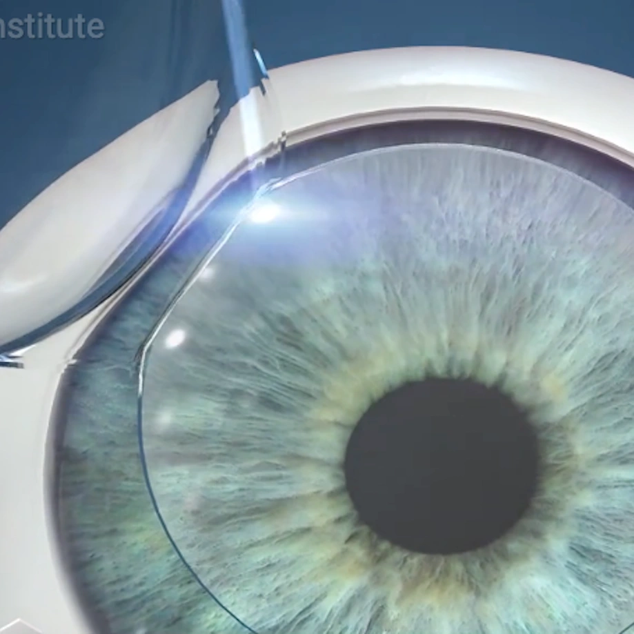lasik video preview