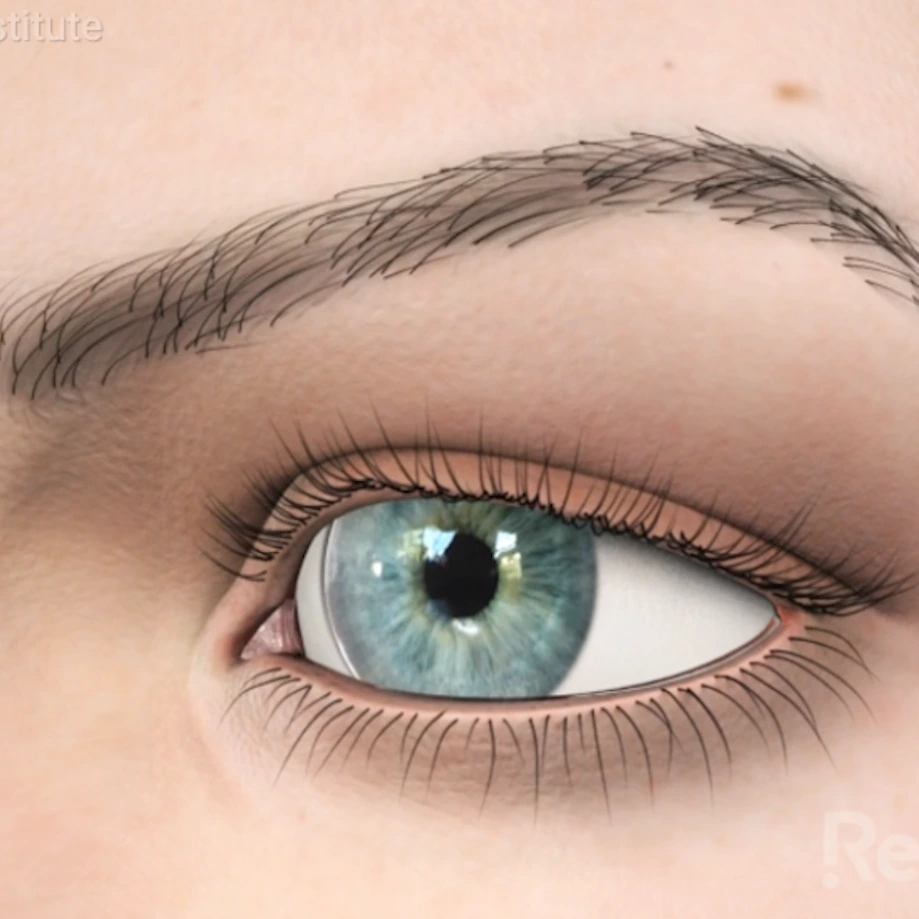 macular edema preview