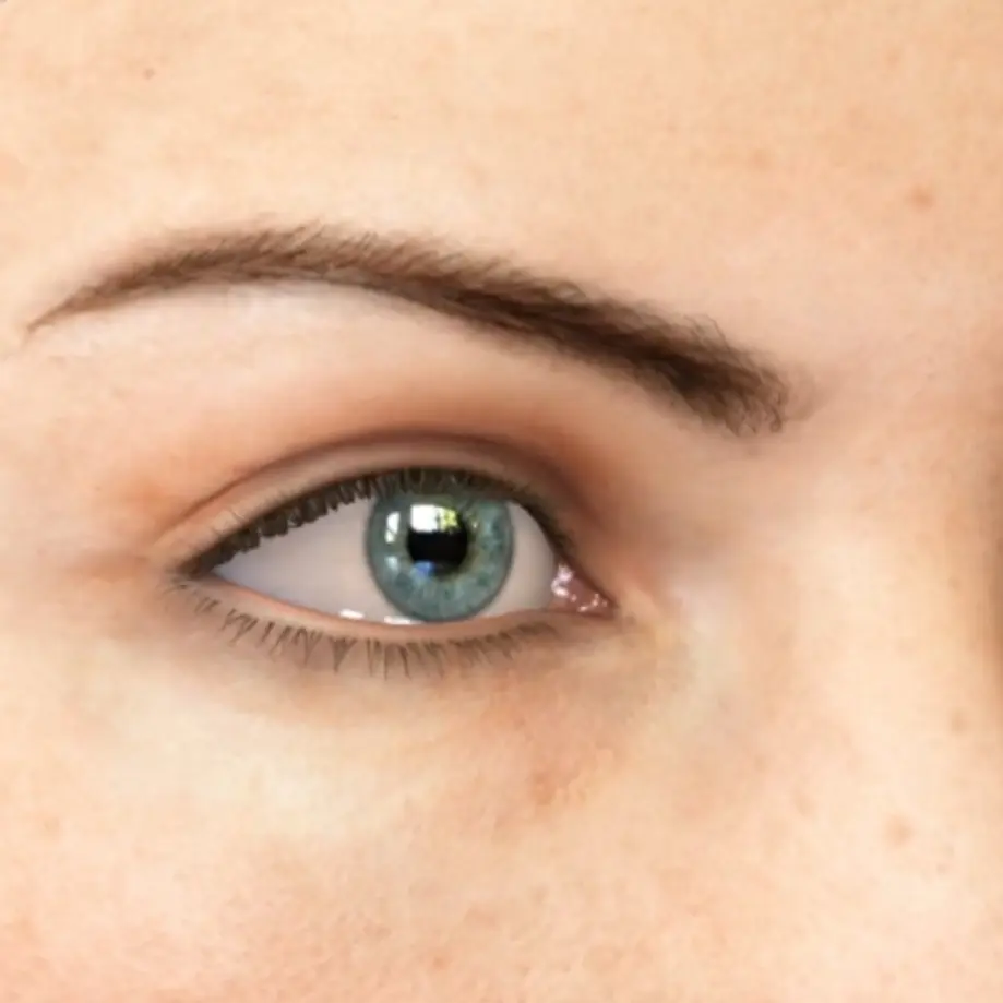 ptosis video preview