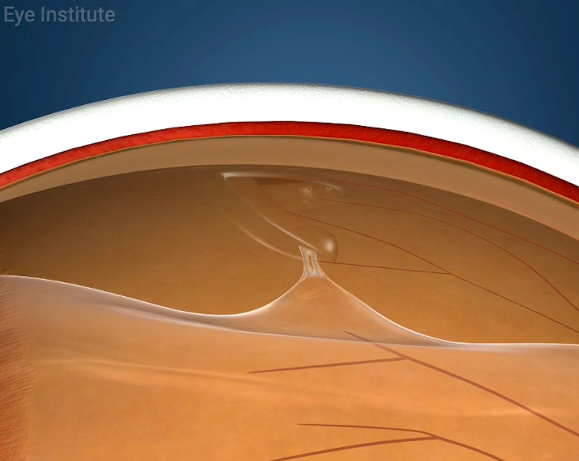 retinal tear video preview