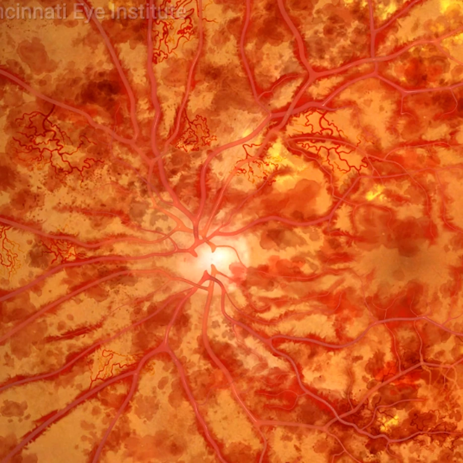 retinal vein preview