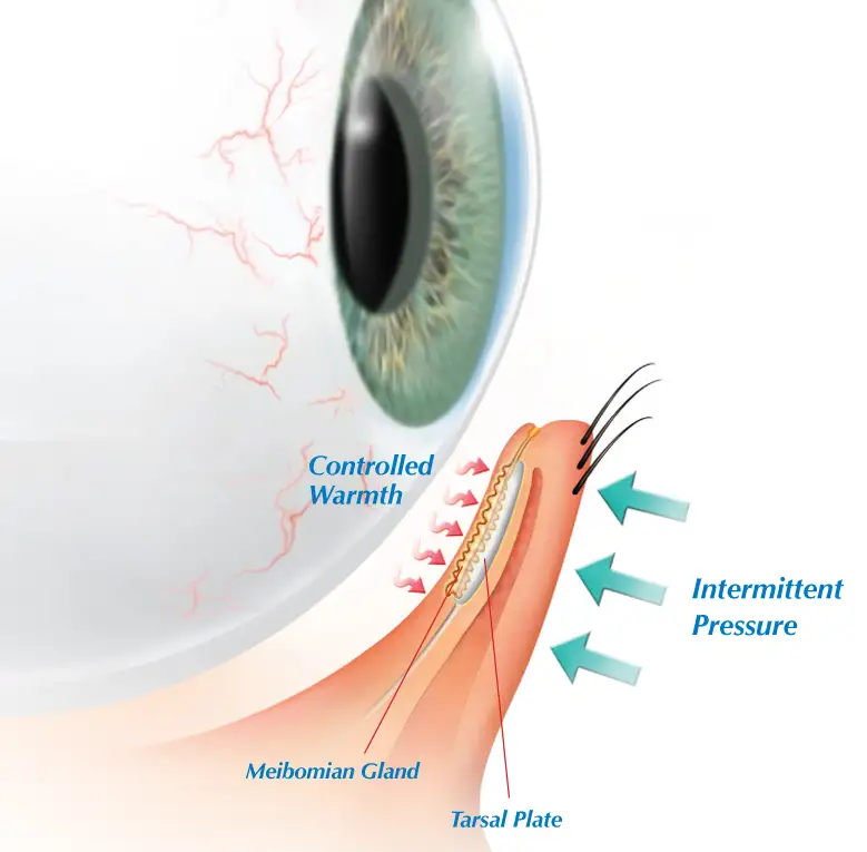 cross section illustration of LipiFlow treatment